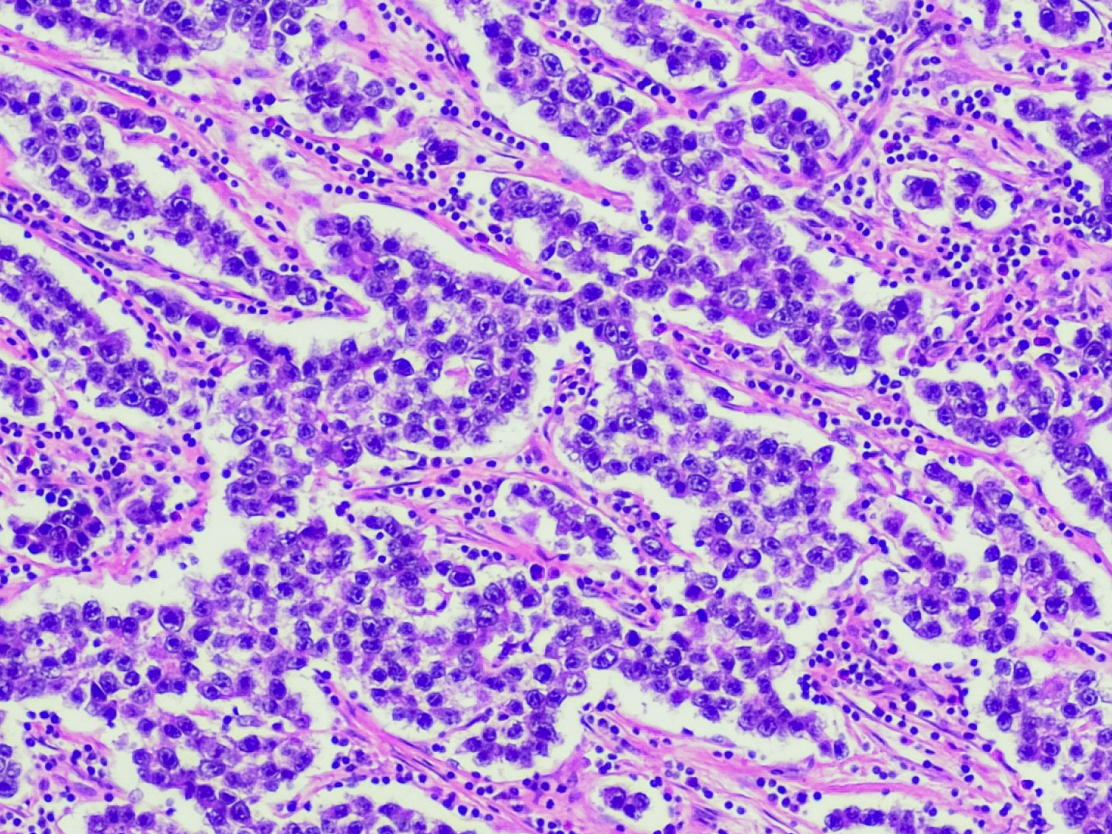 raredisease